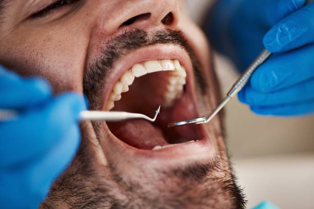 Best Emergency Dentist for Knocked-Out Tooth in St Matthews, SC